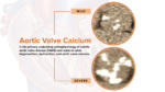 Research Identifies Genetic Clues to Heart Valve Disease, Opening New Paths for Prevention